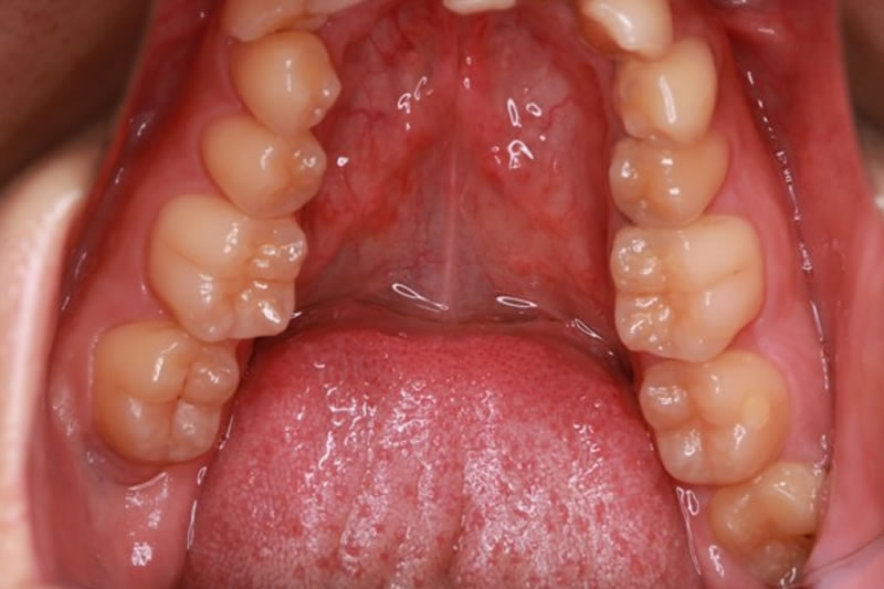 歯周基本治療
