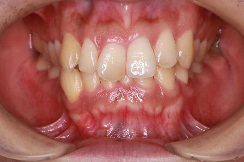 歯周基本治療
