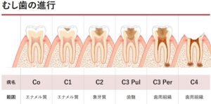 dental-caries-classification-800x398